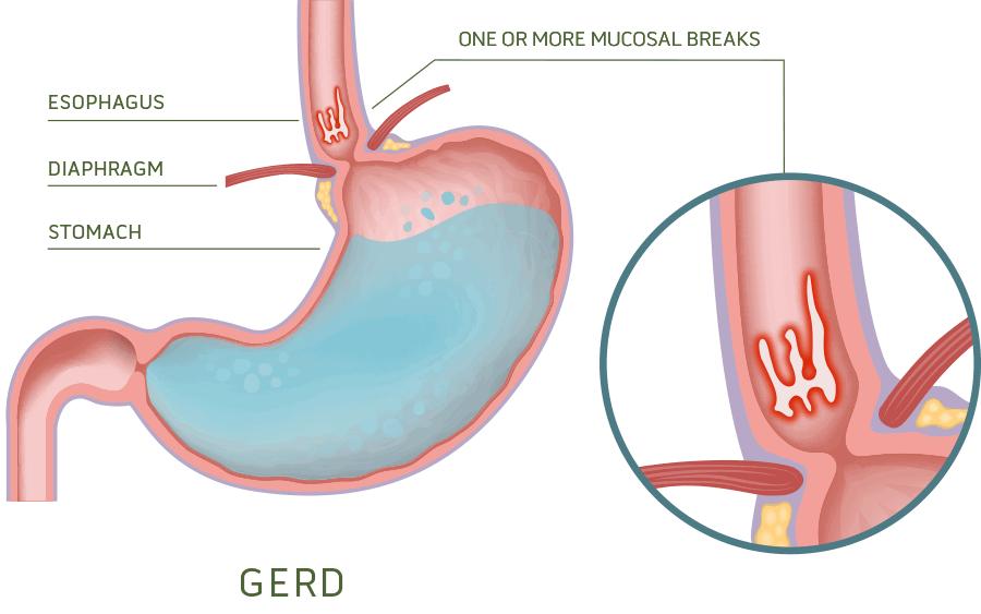 Gastroesophageal Reflux Disease GERD Cinclus Pharma gastroesophageal-reflux-disease-gerd-cinclus-pharma